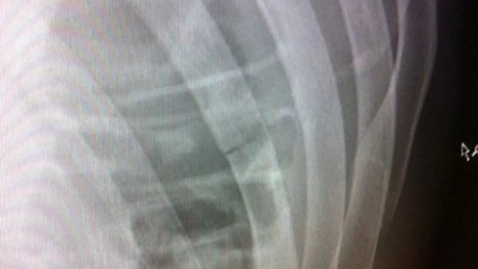 Трещины на грудном. Перелом ребра снимок рентген. Перелом ребер рентгенограмма. Флотирующий перелом ребер рентген. Рентген перелома 2 ребер.
