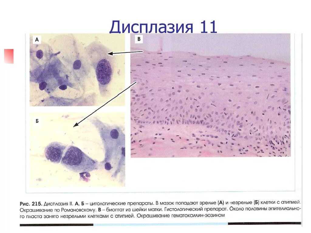 Дисплазия шейки матки микроскопия. Дисплазия шейки матки гистология. Цитология дисплазия эпителия. Группы клеток метаплазированного