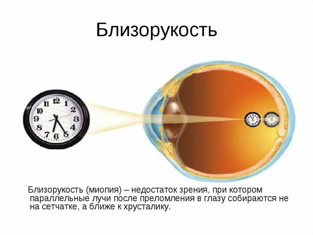 Глаз и зрение физика 9. Близорукость строение глаза. Строение близорукого глаза. Строение глаза миопия. Близорукость недостаток зрения при котором параллельные лучи.