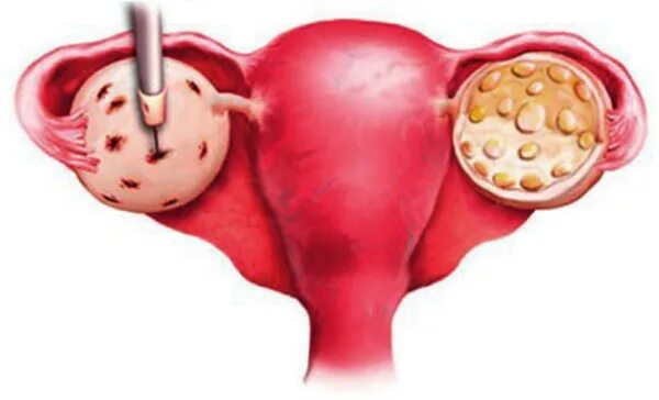 Поликистозные яичники лечение. Поликистоз яичников лапароскопия. Каутеризация (Дриллинг) яичников. Синдром поликистозных яичников операция.