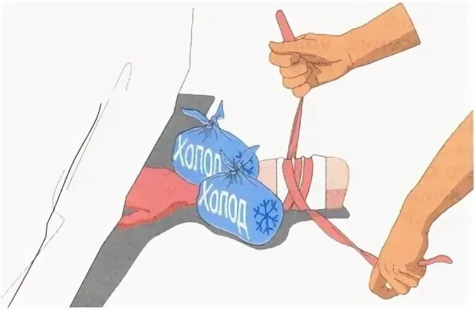 Сдавливание конечностей
