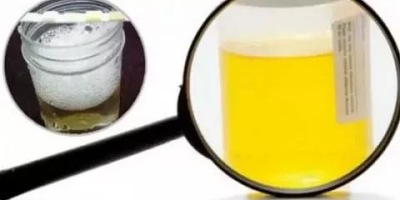 как выглядит белок в моче фото