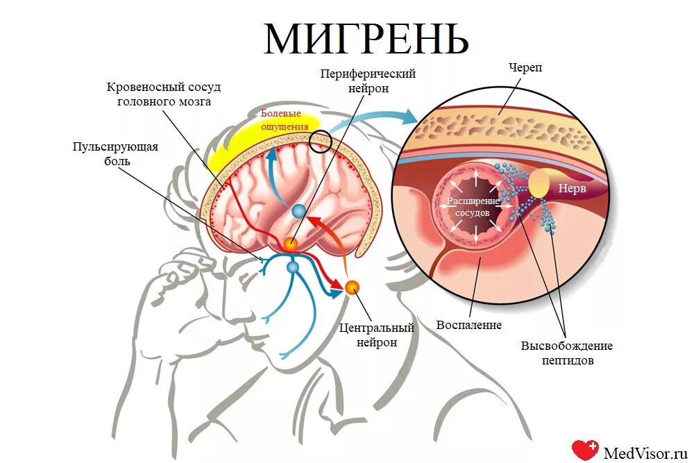 Что происходит при мигрени. Мигрень головного мозга. Мигрень механизм возникновения. Мозг при мигрени. Мигрень и сосуды головного мозга.