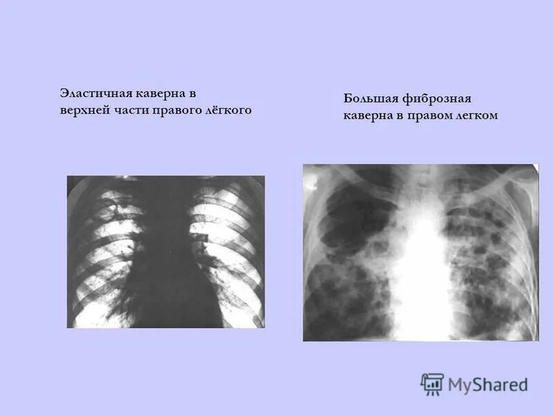отличие туберкулезной пневмонии от обычной. таблица дифференциальной диагностики пневмоний. чем отличается туберкулез от пневмонии. туберкулёз или пневмония как отличить. дифференциальный диагноз очаговой пневмонии.