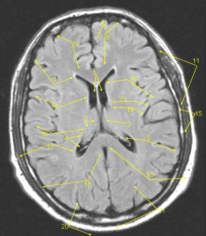 Головной мозг сильвиев водопровод. Проекция желудочков головного мозга. Стенки третьего желудочка мозга. Задние рога боковых желудочков мозга. Боковые желудочки конечного мозга.