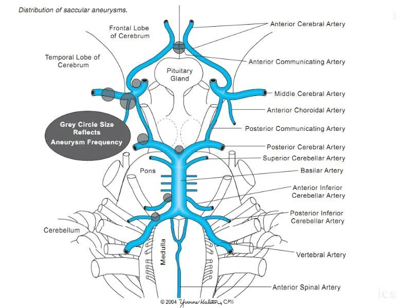 Аневризмы головного мозга классификация. Аневризмы сосудов головного мозга классификация. Аневризма базилярной артерии головного мозга кт. Аневризма передней соединительной артерии головного мозга кт. Аневризма мозга простыми словами
