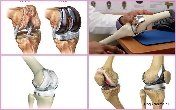 Гонартроз эндопротезирование коленного сустава. Дефартроз коленного сустава. Гонартроз коленного сустава 1. Деформирующий гонартроз коленного сустава. Артроз коленного сустава название