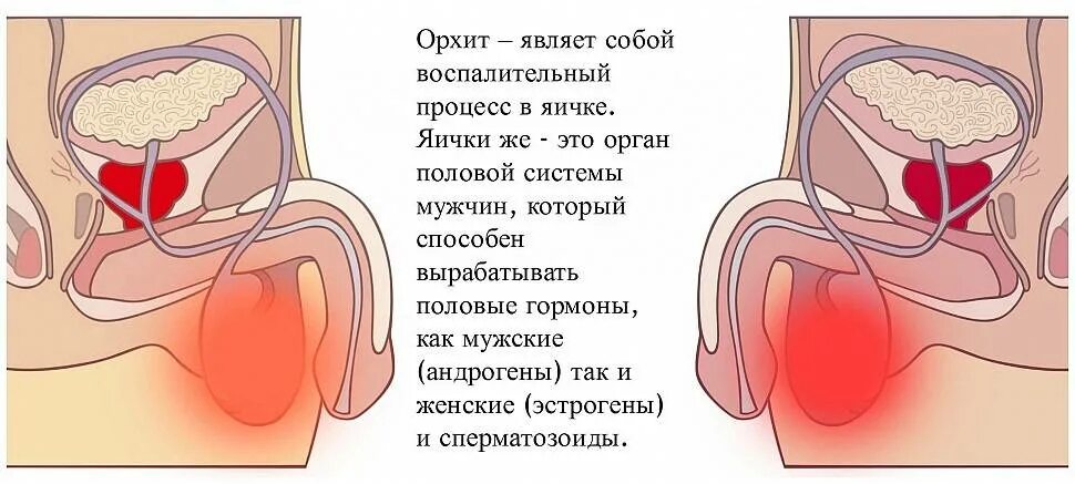 Орхит симптомы. Орхит (воспаление яичка). орхита паротитной этиологии.