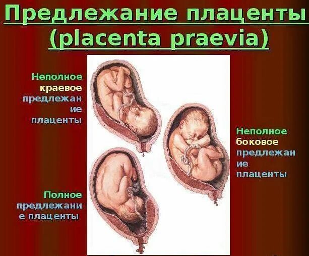 Предлежание плаценты. Краевое предлежание плаценты. Предлежание плаценты при беременности. Центральное боковое и краевое предлежание плаценты.