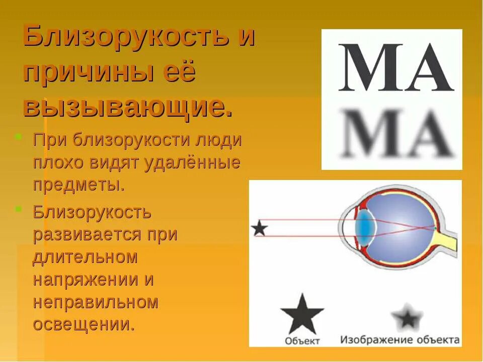 Плохо видят предметы. Сложный гиперметропический астигматизм. Аномалии рефракции глаза близорукость дальнозоркость таблица. Нормальное зрение дальнозоркость близорукость. Близорукость.