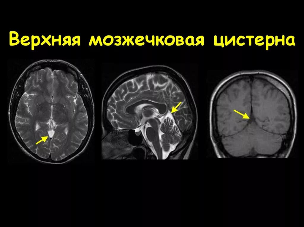 Большая цистерна больше нормы. Расширение мозжечковой цистерны кт. Мозжечковая цистерна мозга. Базальная цистерна мозга кт. Арахноидальная киста цистерны четверохолмия.