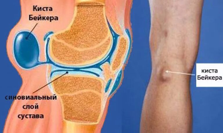 Киста коленного сустава отзывы