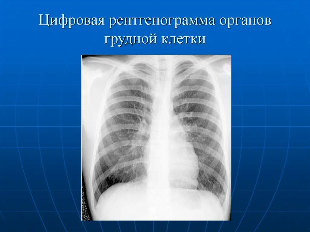 Рентгенограмма органов грудной клетки