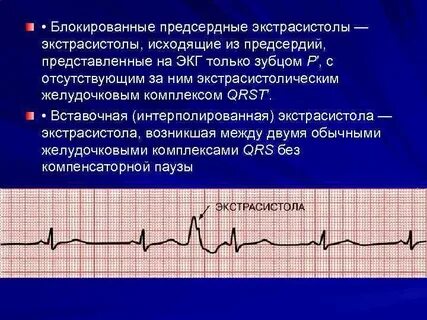 Экстрасистолы на экг