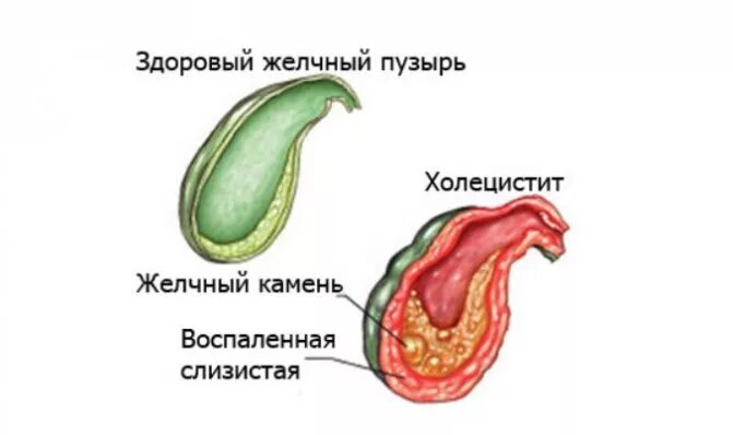 Желчный пузырь глаза