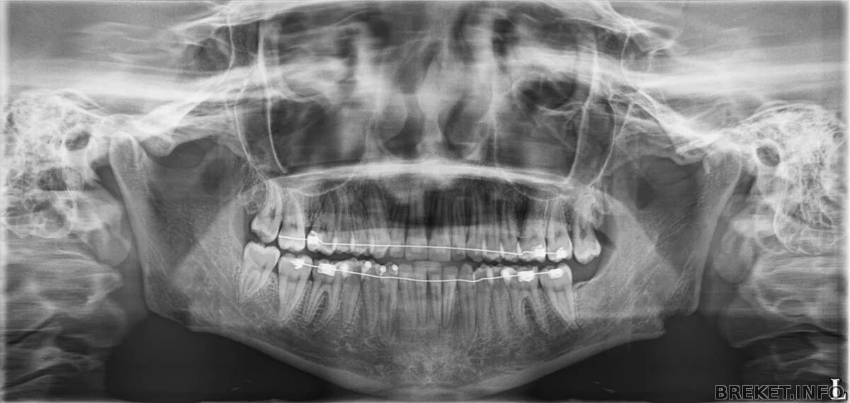 Мрт можно делать с брекетами на зубах. Панорамный снимок зубов с брекетами.