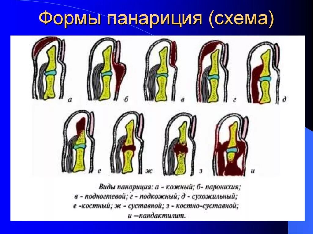 Классификация панарициев. Посттравматический панариций. Классификация подногтевой панариция. Классификация панарициев хирургия. Поверхностные формы панариция.