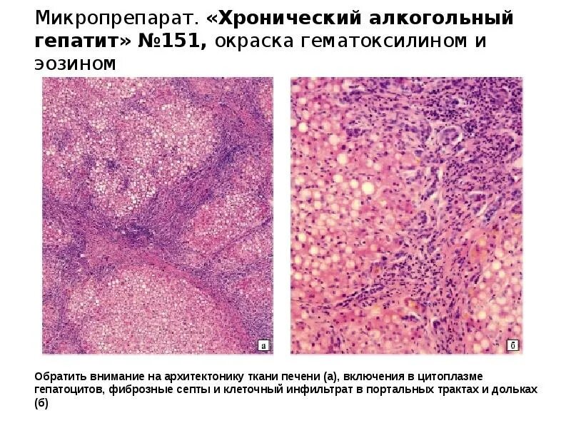 Печень микропрепарат описание. Алкогольный цирроз печени микропрепарат. Интерстициальный гепатит микропрепарат. Алкогольный гепатит микропрепарата. Гемосидероз печени гистология.