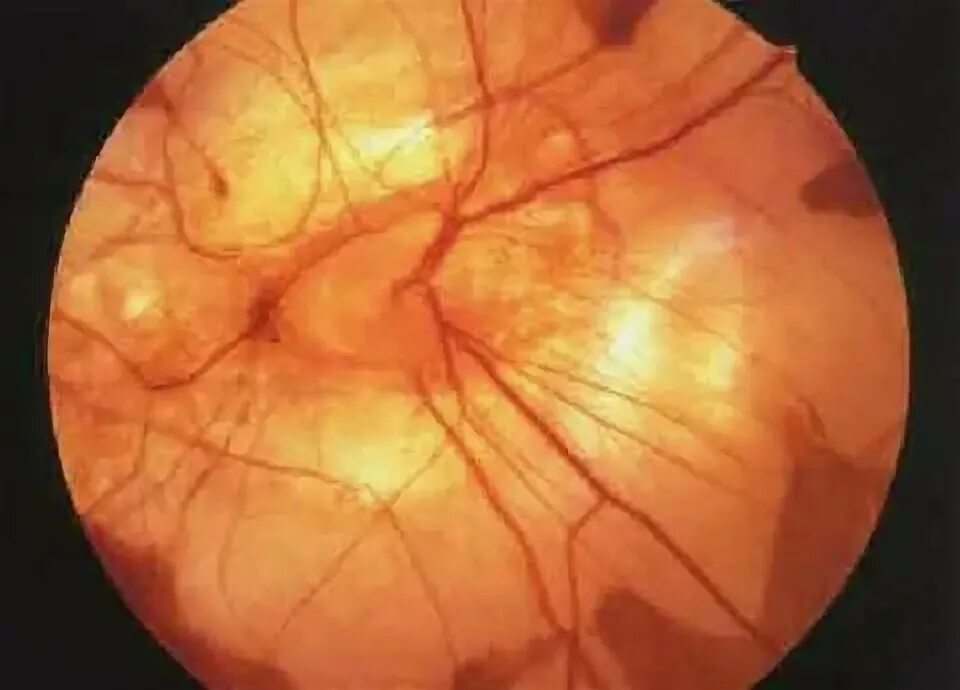 Миопическая стафилома сетчатки. Миопический конус глазное дно.