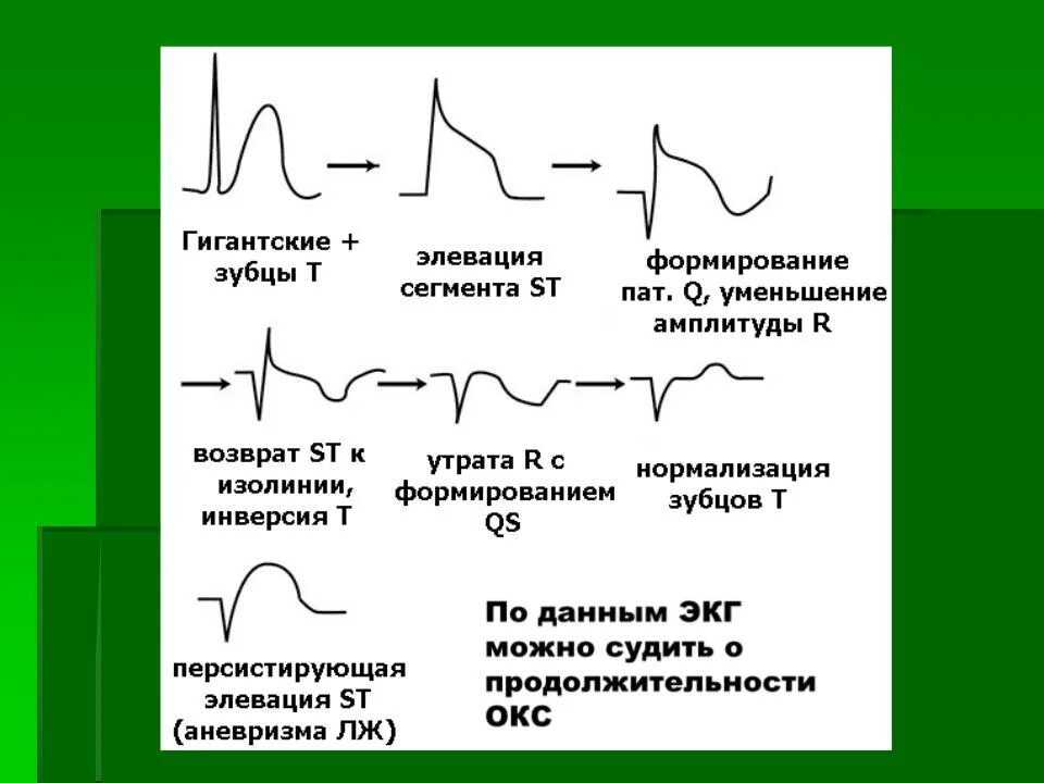 Отрицательный зубец р после QRS комплекса. ЭКГ инфаркт миокарда с подъемом St. Инфаркт миокарда ЭКГ v1 v2 v3. Сегмент St на ЭКГ В норме и патологии. Тяжелое экг