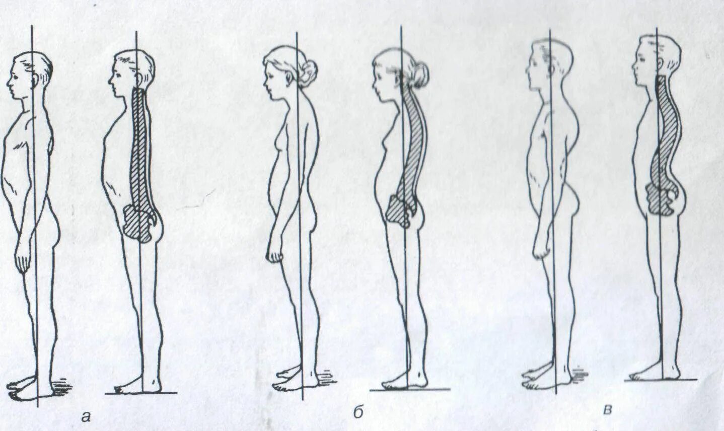 Нарушения осанки рисунки