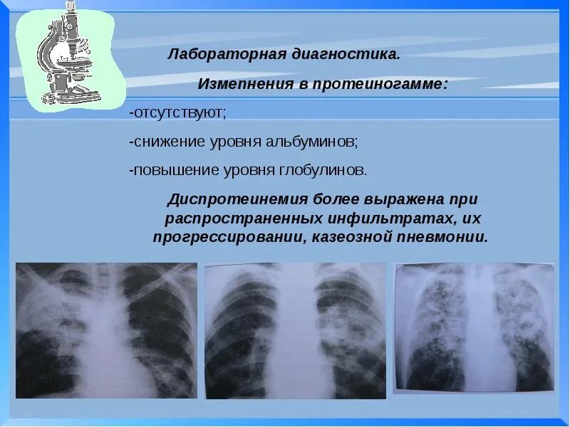 Прогрессирующий туберкулез легких. Бронхолобулярный инфильтративный туберкулез рентген. инфильтративный туберкулез диагноз. инфильтративный туберкулез клиника. инфильтративный туберкулез ассмана.