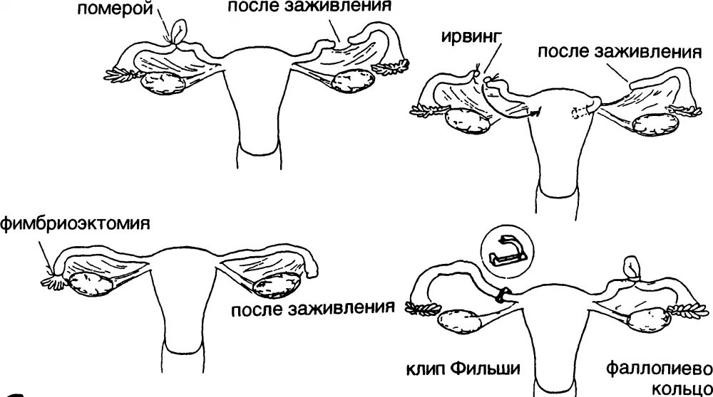 Добровольная хирургическая стерилизация методики. Женская стерилизация (метод Помероя). Перевязка маточных труб по Кохеру. Перевязка маточных труб методом лапароскопии.