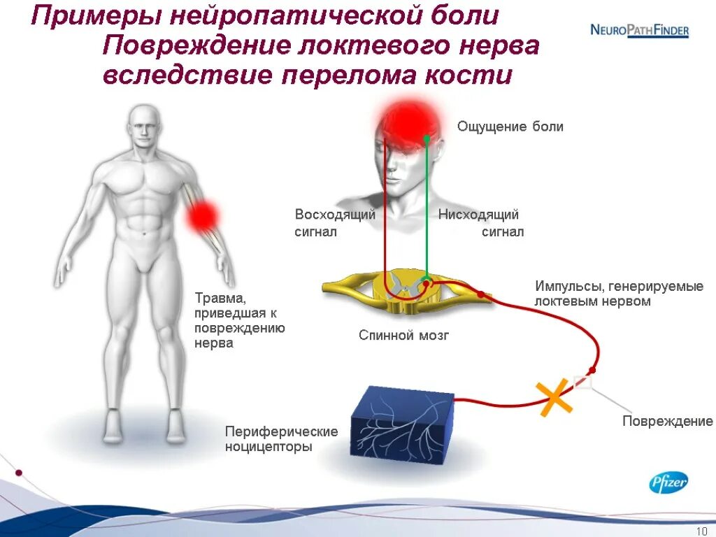 Нейропатическая боль в спине. Что такое нейролептические боли. Примеры нейропатической боли. Невропатическая и нейропатическая боль. Схема нейропатической боли.