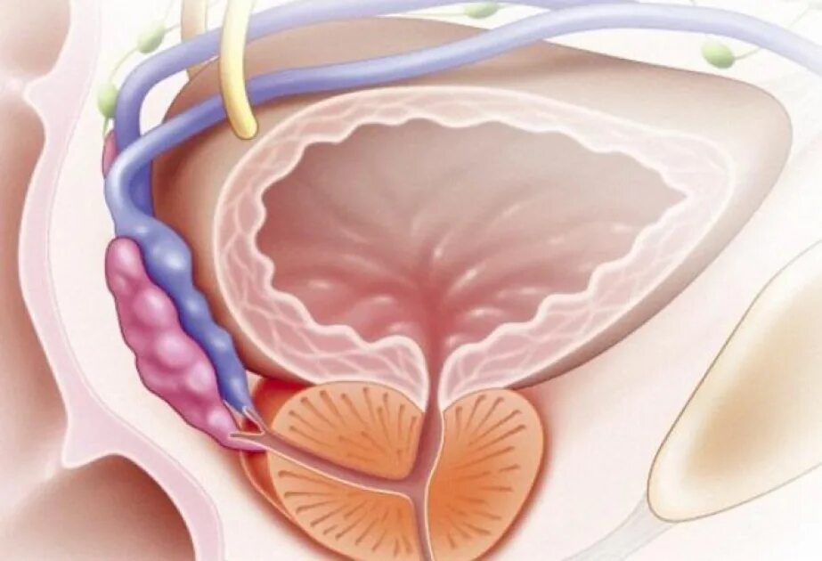 Заболевания предстательной железы. Киста предстательной железы. Ткань простаты