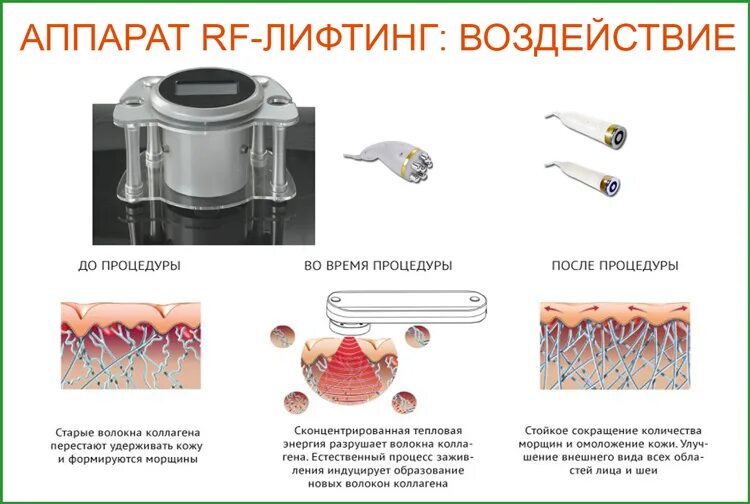 Rf лифтинг вред. Игольчатый РФ лифтинг принцип действия. Схема РФ лифтинга тела. РФ лифтинг принцип действия. РФ лифтинг воздействие.