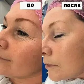 Безинъекционная мезотерапия до после