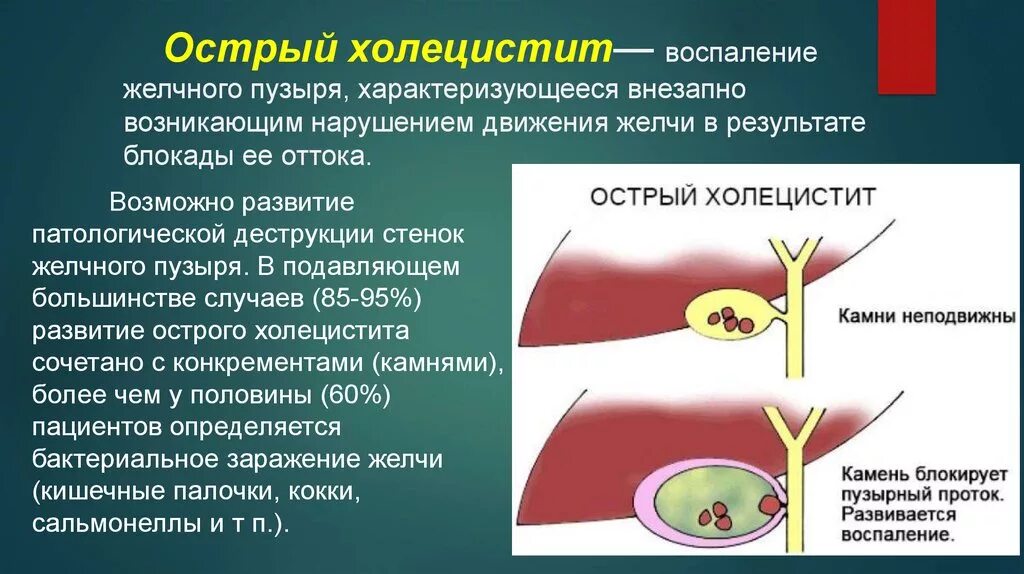 Острый и хронический холецистит. Хронический холецистит желчного пузыря симптомы. Желчный пузырь при хроническом холецистите. Нарушение желчеоттока