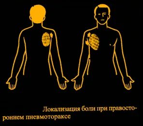 При кашле отдает в грудную клетку