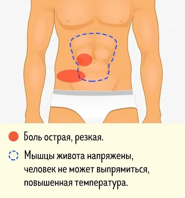 Колики аппендицит. Локализация боли в животе. Болит вся область живота. Рези возле пупка. Болит справа посередине живота.