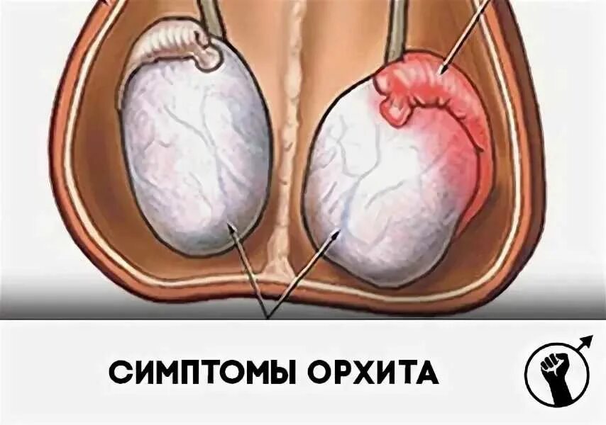 Воспаление придатка яичка симптомы. Воспаление яичек орхит симптомы.