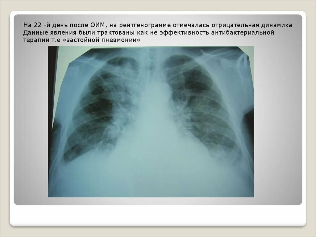 Застойная пневмония рентген. Застойная пневмония рентгенограмма. Гипостатическая пневмония рентген. Гипостатические изменения в легких