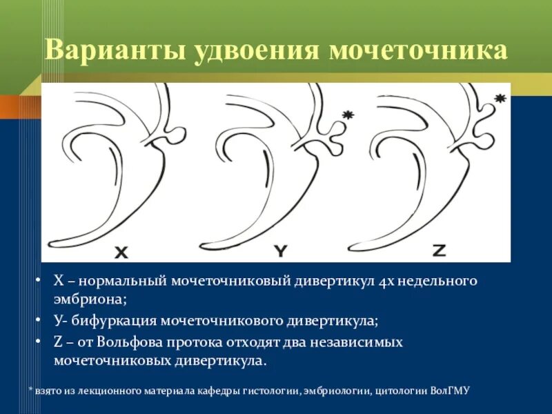 Удвоение мочеточника. Аномалии развития мочеточников. Дивертикул мочеточника. Аномалии формы мочеточника. Пороки развития мочеточника.