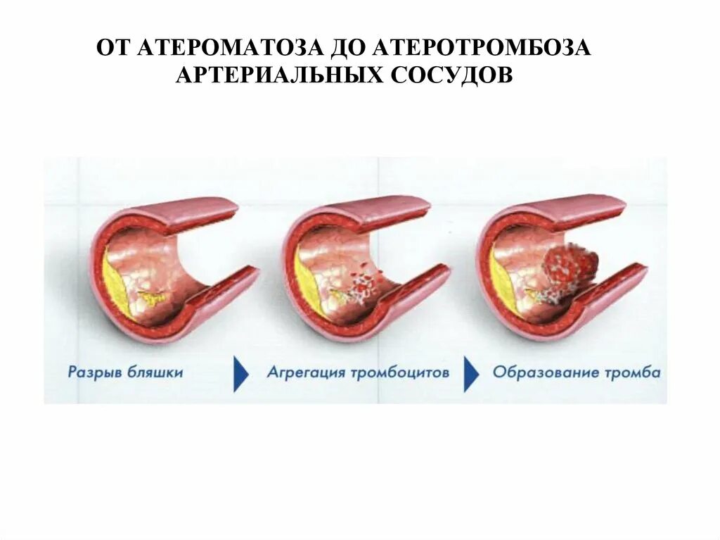 Механизм атеротромбоза. От атероматоза до атеротромбоза артериальных сосудов.