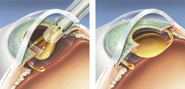 Аккомодирующие ИОЛ. Ультразвуковая факоэмульсификация катаракты. Ультразвуковое хирургия катаракты - факоэмульсификация.