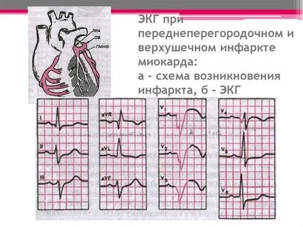 Передне перегородочная область на экг