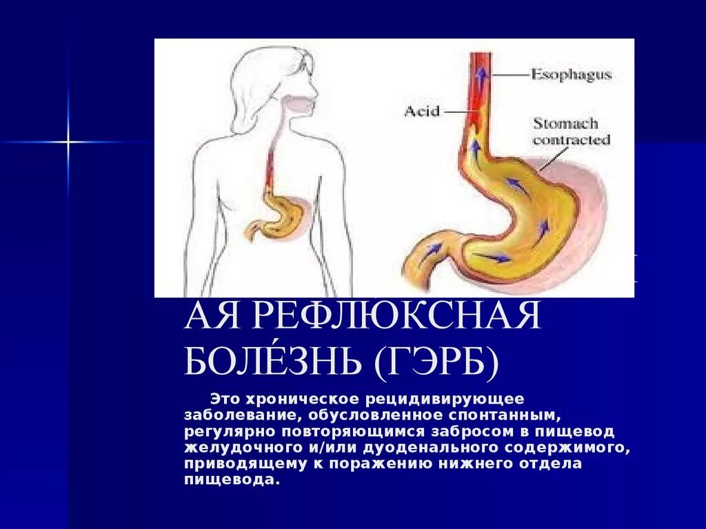 Рефлюксная болезнь пищевода. Односторонний рефлюкс ГЭРБ. Заболевания пищевода у детей.