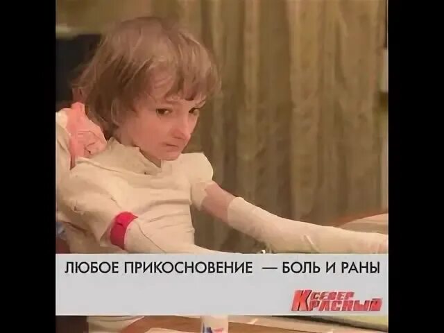 В Тольятти собирают пластиковые крышки, чтобы помочь "девочке-бабочке" - Волга Н