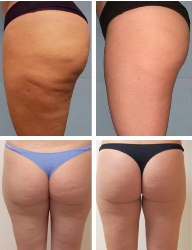 липолитики для похудения отзывы. Ppc липолитик. мезотерапия живота для похудения. живот после липолитиков. липолитики в живот до и после.