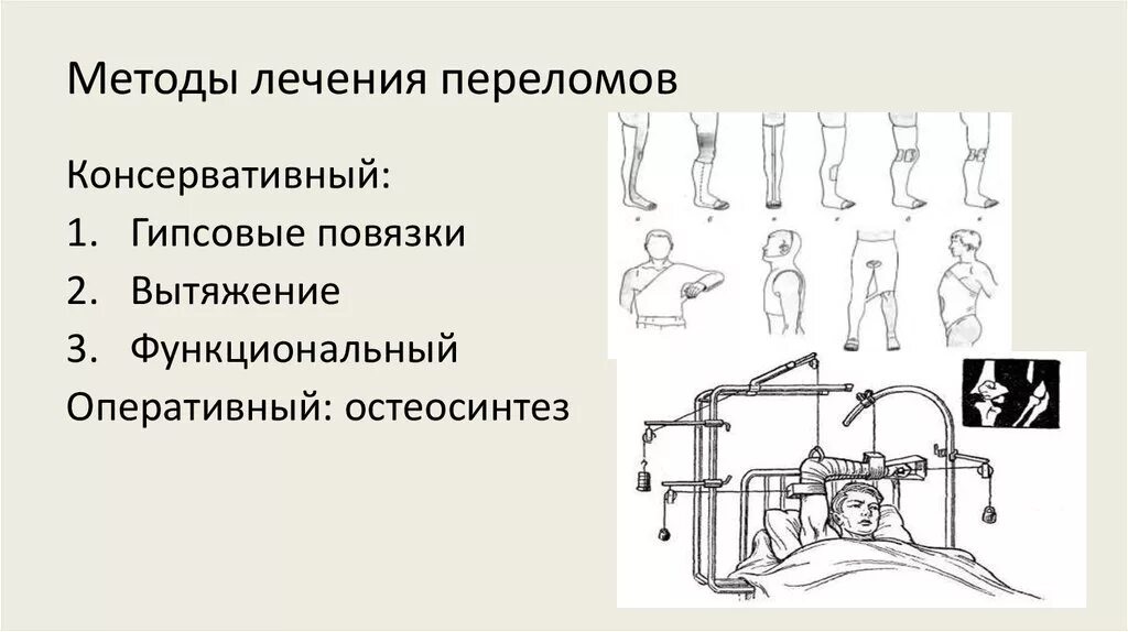 Принципы оперативного лечения переломов. Принципы хирургического лечения переломов. Консервативные методы лечения переломов. Принципы консервативного лечения переломов.