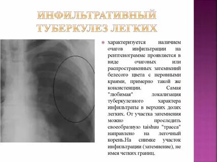 Разрешение инфильтрации в легких