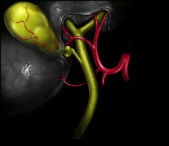 Болезнь желчных протоков. Кт анатомия желчных протоков. Аномалии пузырного протока. Холангиография через желчный пузырь. Опухоль желчного пузыря кт.