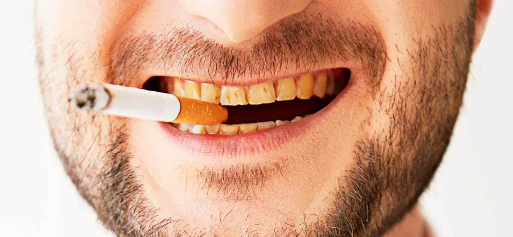 Курить после лечения зуба. Зубы курильщика пародонтоз.