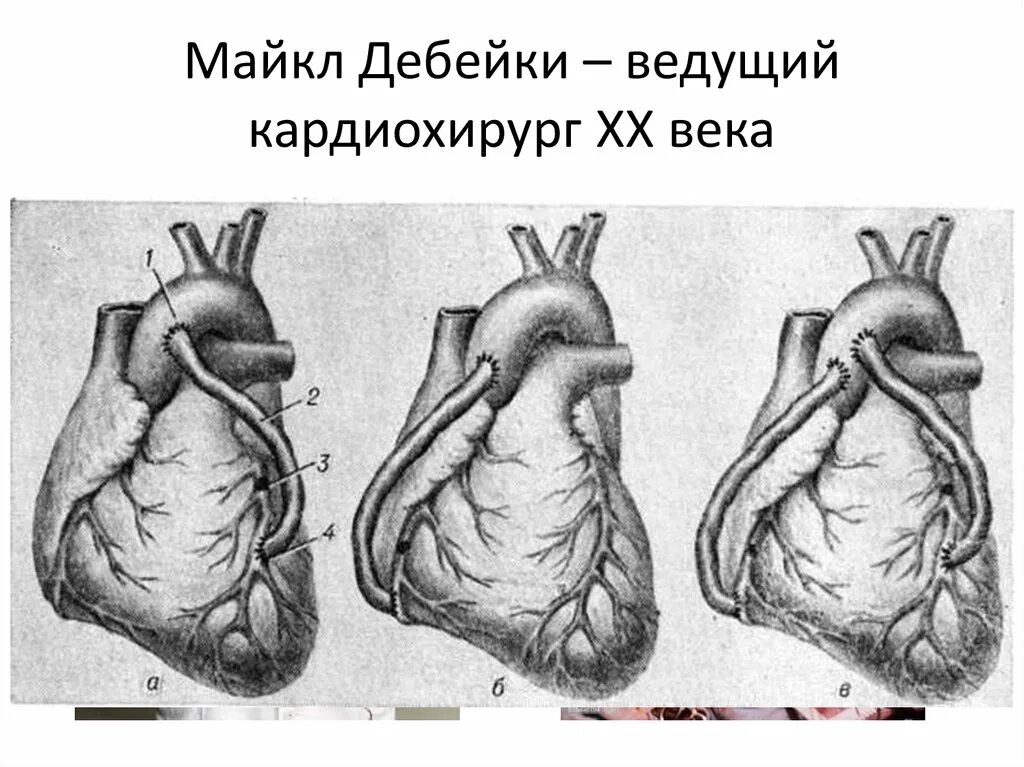 Операция коронарный сосуд. Аорта коронарное шунтирование. Аортокоронарное шунтирование (АКШ). Артерио коронарное шунтирование. Аортокоронарное шунтирование ход операции.