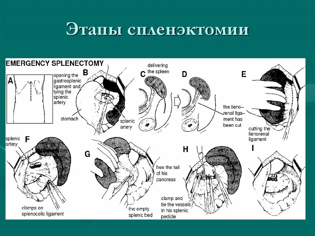 Спленэктомия что это. Спленэктомия техника операции. Ход операции с пленэктомией.