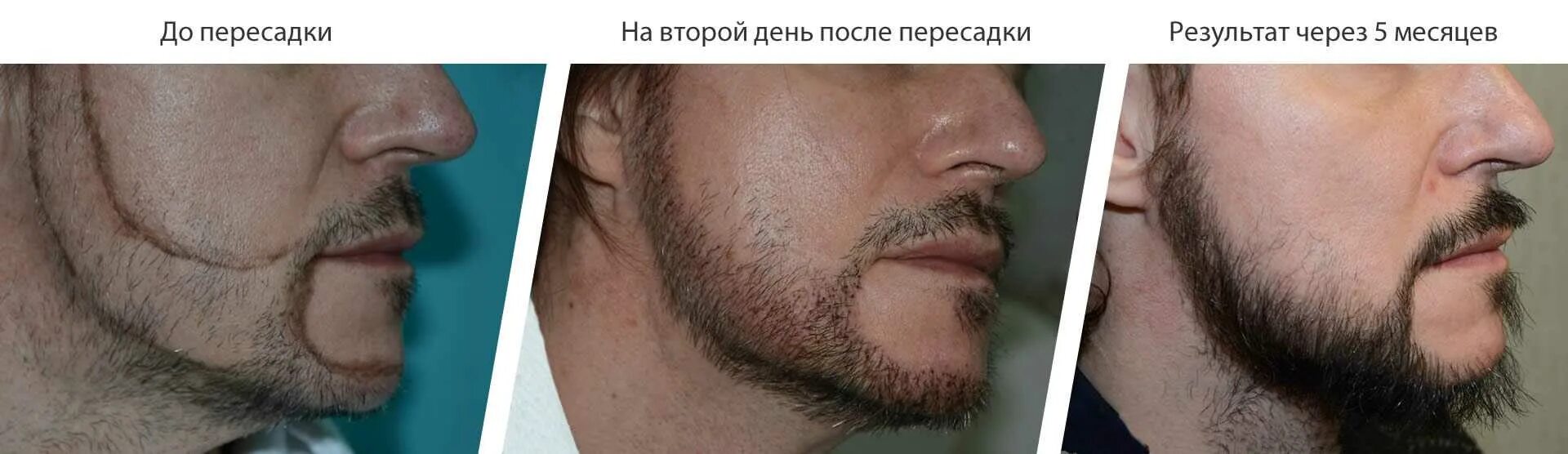 Рост волос на лице у мужчин. Пересадка бороды до и после. Трансплантация волос на бороду. Трансплантация бороды до после. Пересадка волос на бороду до и после.